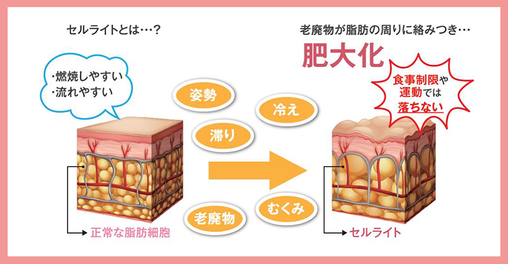 セルライトとは?